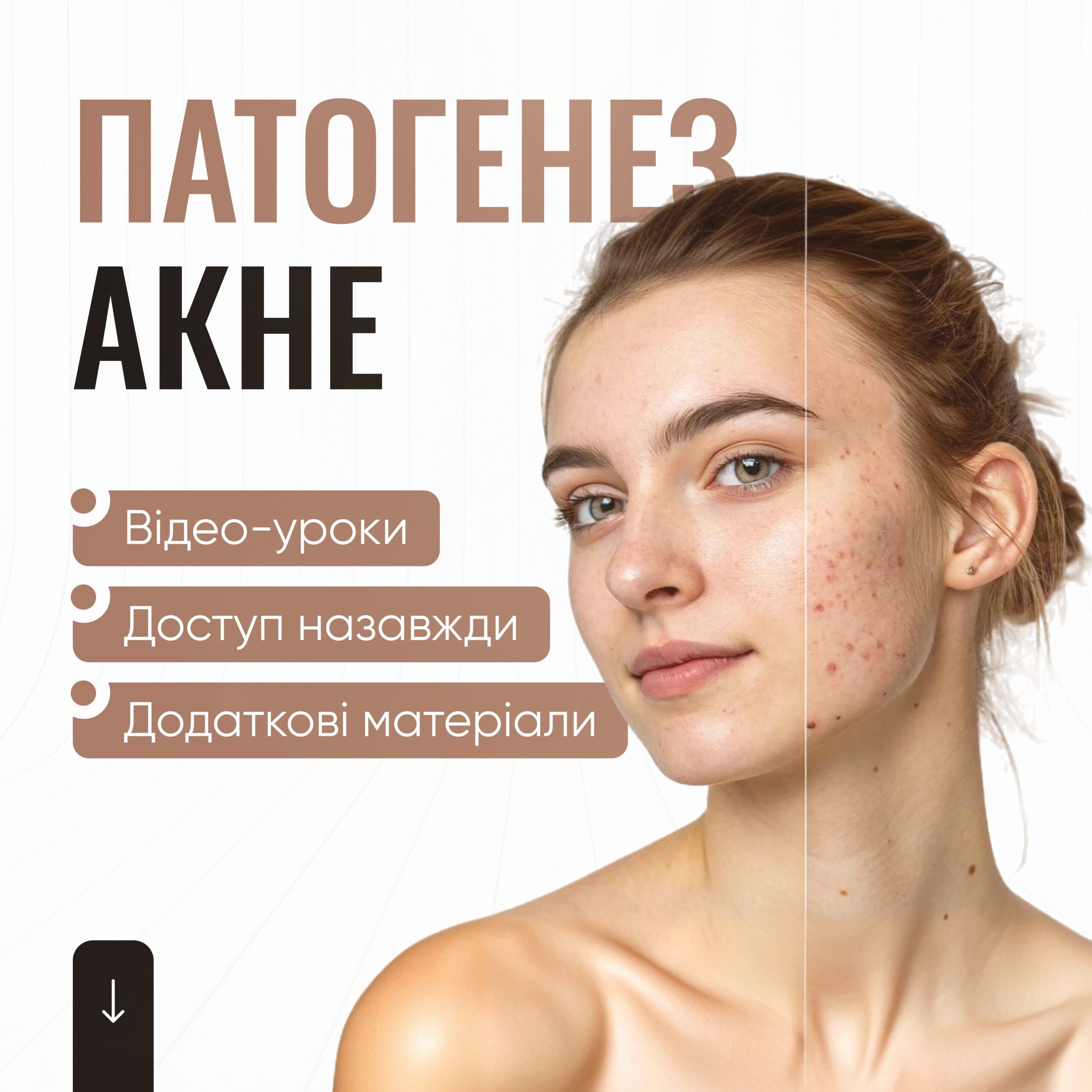 Патогенез акне