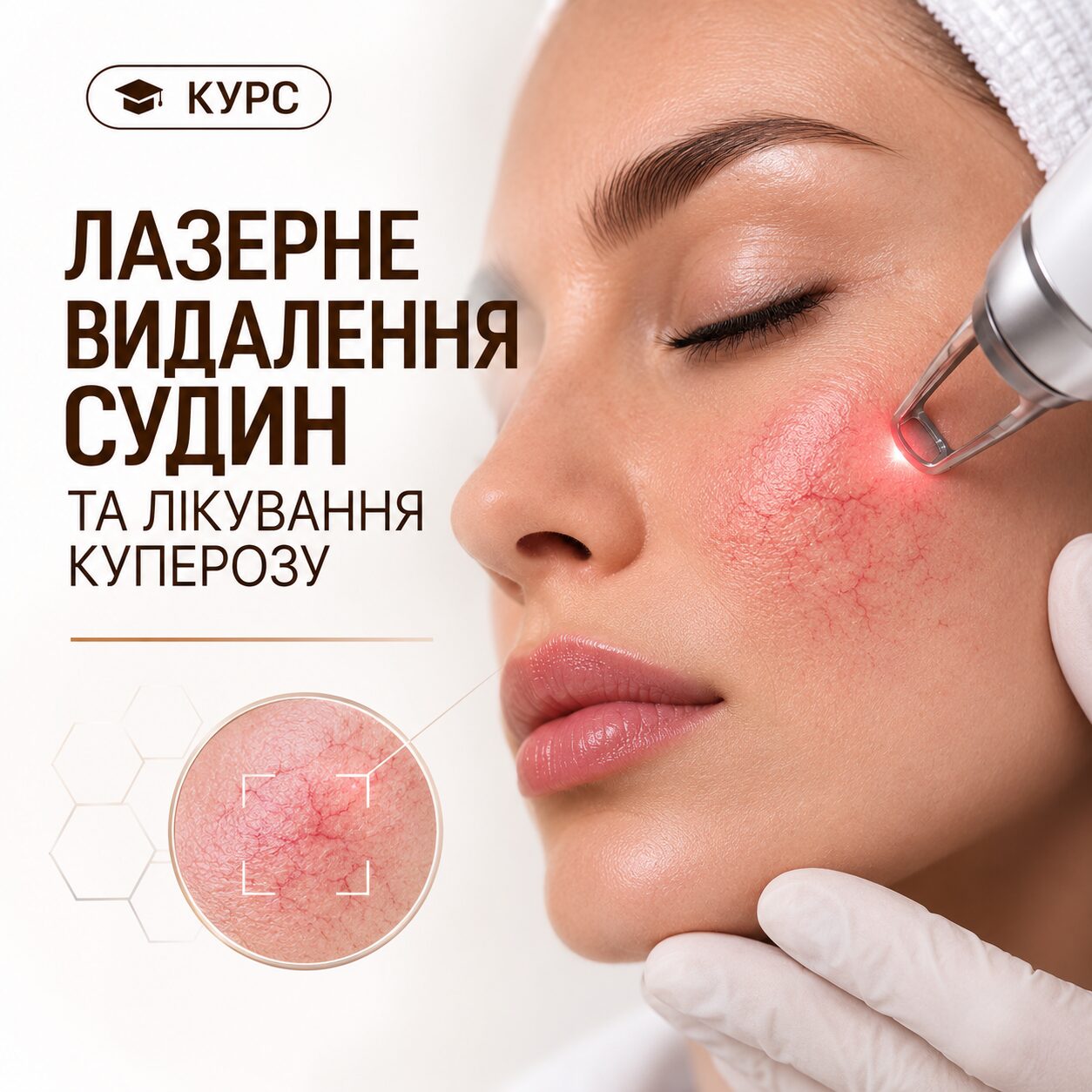 Лазерное удаление сосудов и лечение купероза