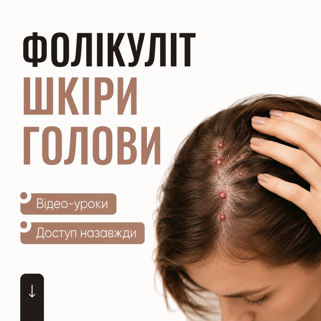 Фолікуліт шкіри голови
