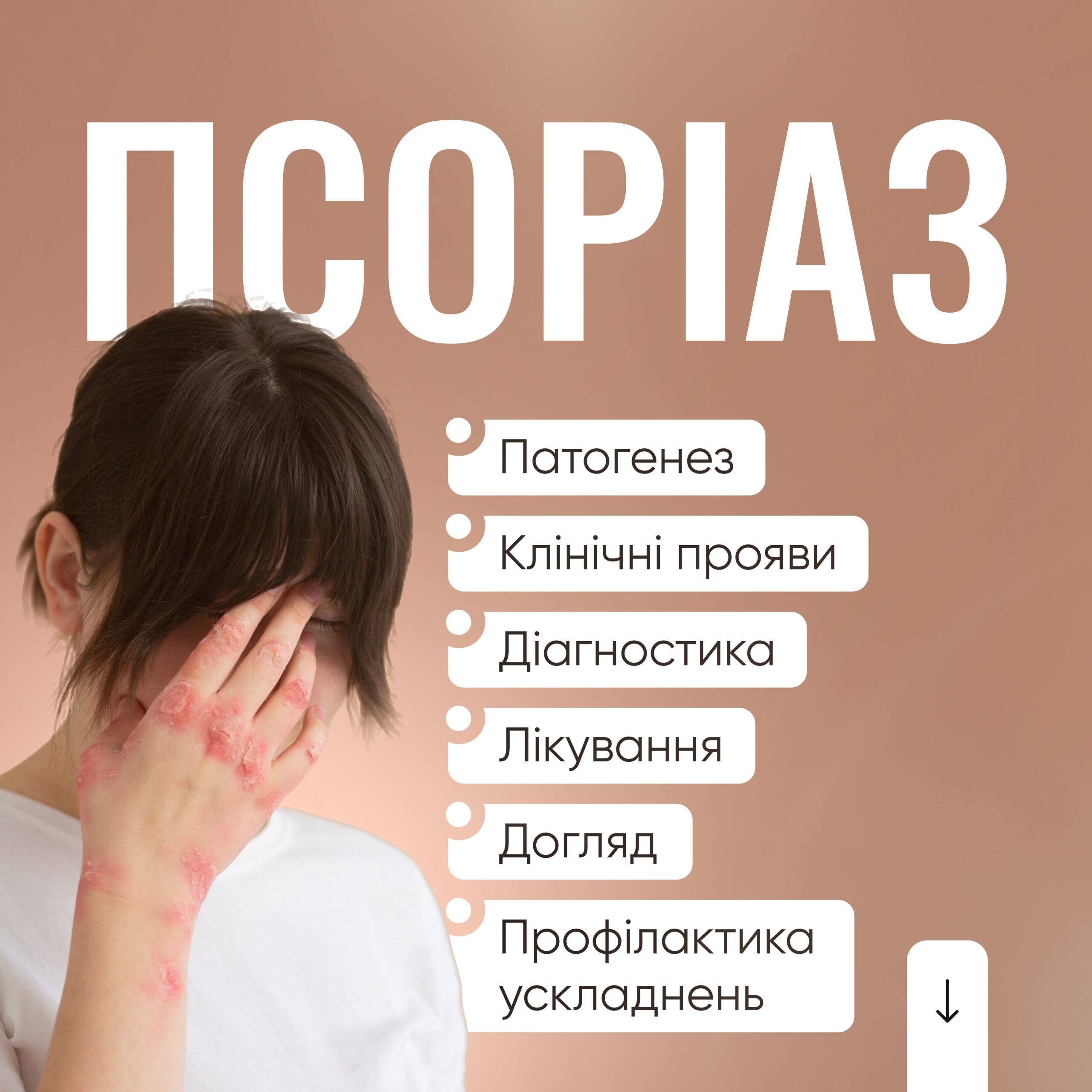 Псоріаз