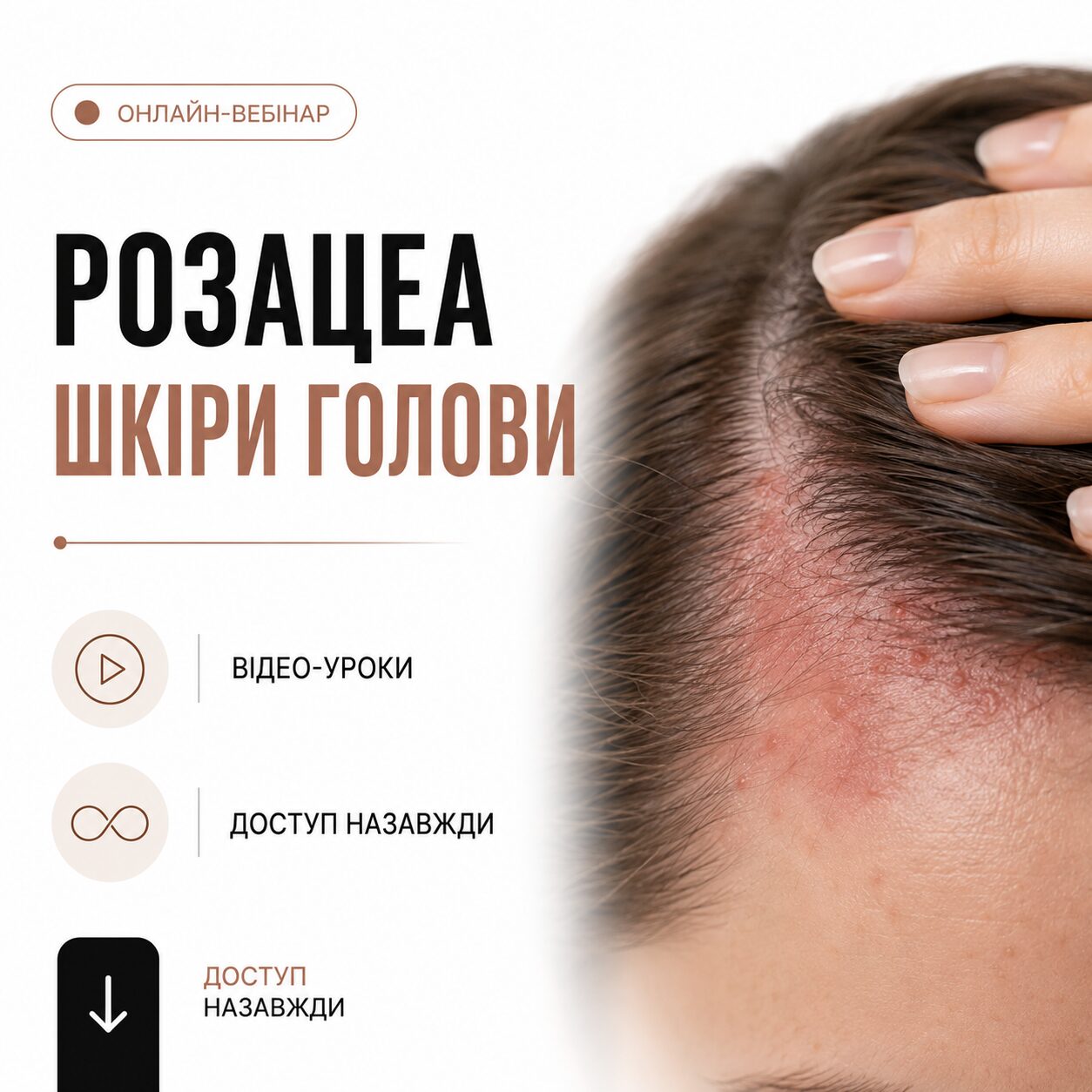 Розацеа шкіри голови